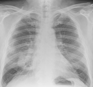 Lung Cancer